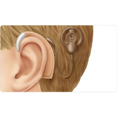 Photo of cochlear