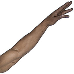 Photo of arm